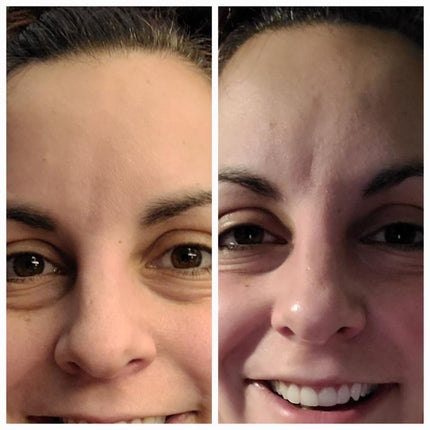 before and after from a frownies customer using frownies facial patches FBE