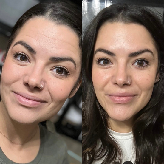 before and after using frownies facial patches for horizontal forehead wrinkles