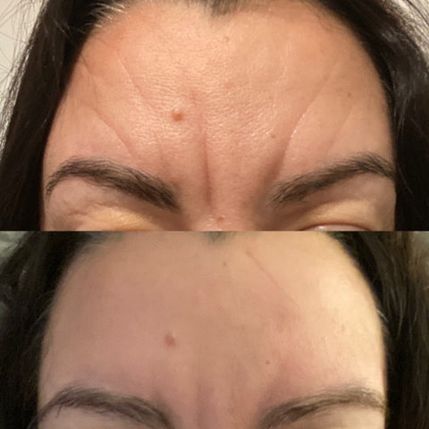 Before and after wrinkle patches Wrinkles on the forehead before using Frownies Facial Patches for smoothing wrinkles and lines and the same woman after using Frownies for forehead and between the eyes wrinkle patches the wrinkles are softened and smoothed