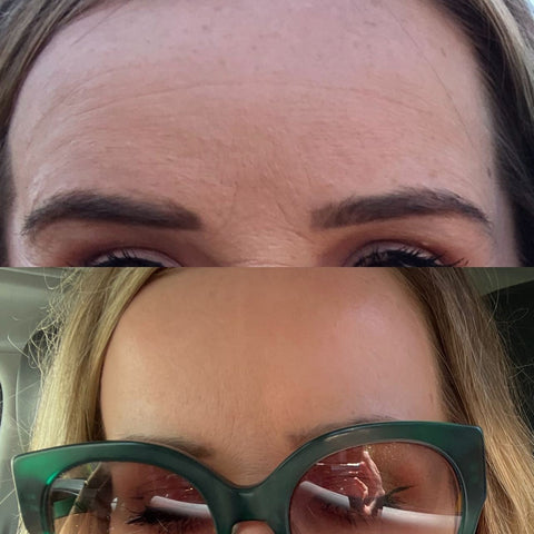 Before and after wrinkle patches Wrinkles on the forehead before using Frownies Facial Patches for smoothing wrinkles and lines and the same woman after using Frownies for forehead and between the eyes wrinkle patches the wrinkles are softened and smoothed