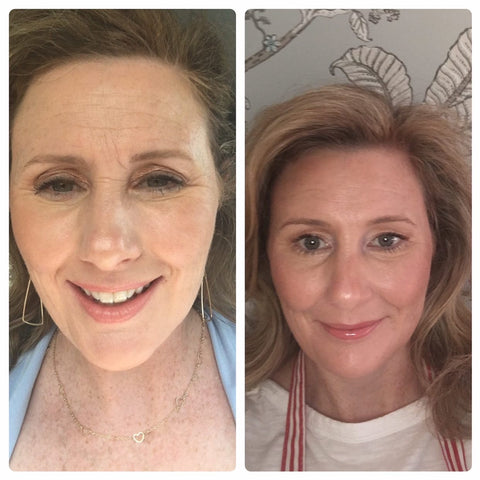 Wrinkles on the forehead before using Frownies Facial Patches for smoothing wrinkles and lines and the same woman after using Frownies for forehead and between the eyes wrinkle patches the wrinkles are obviously softened and smoothed