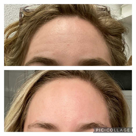Before and after wrinkle patches Wrinkles on the forehead before using Frownies Facial Patches for smoothing wrinkles and lines and the same woman after using Frownies for forehead and between the eyes wrinkle patches the wrinkles are softened and smoothed