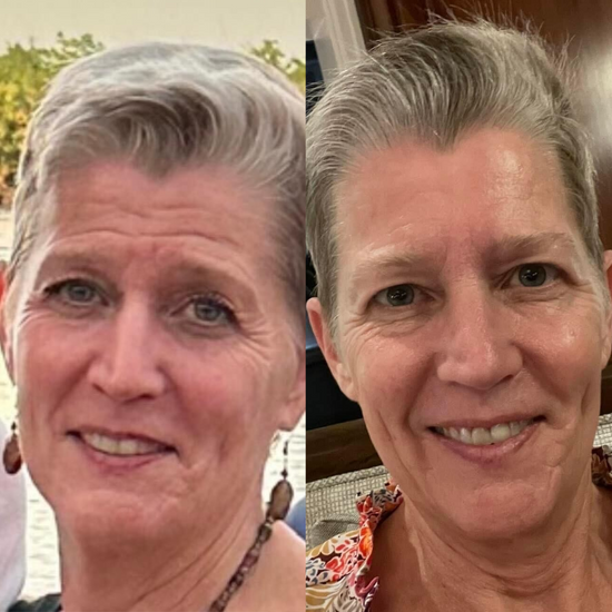 mature skin before and after using frownies facial patches 