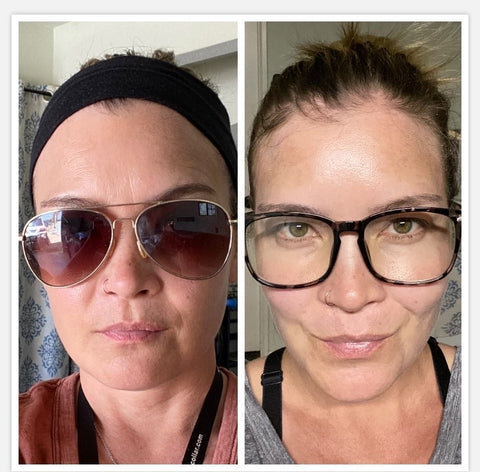before frownies patches were worn wrinkles on the forehead can be seen after frownies patches wrinkles are not seen on the forehead and between the eyes