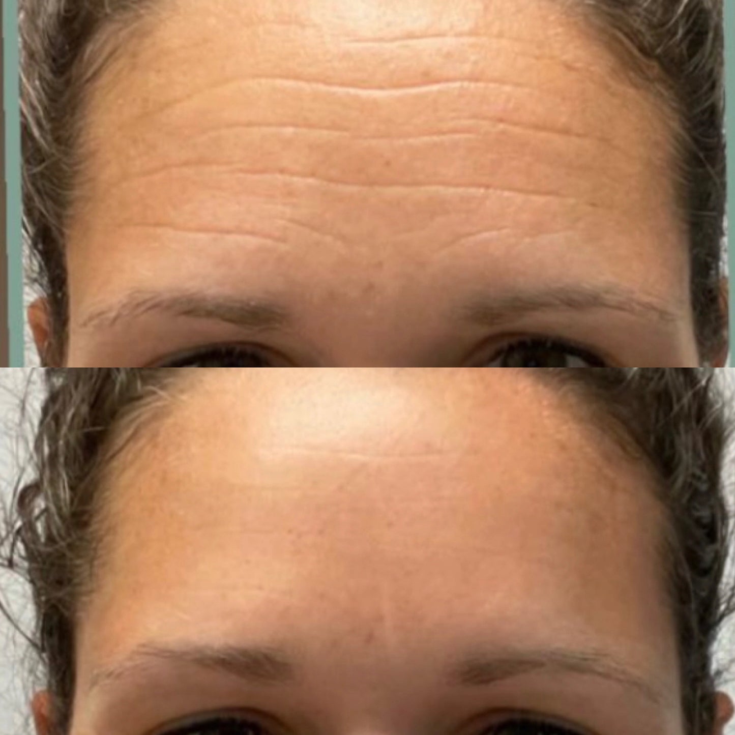 Before-and-after photo of a man’s forehead after using Frownies facial patches. The 'before' image shows visible expression lines, while the 'after' image shows his forehead with smoothed and softened expression lines