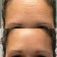 Before-and-after photo of a man’s forehead after using Frownies facial patches. The 'before' image shows visible expression lines, while the 'after' image shows his forehead with smoothed and softened expression lines