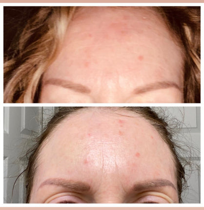 before and after from a frownies customer using frownies facial patches FBE