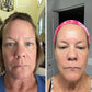 Before-and-after photo of a woman using Frownies: The 'before' image shows noticeable forehead wrinkles, while the 'after' image highlights her forehead as smooth, refined, hydrated, and glowing.