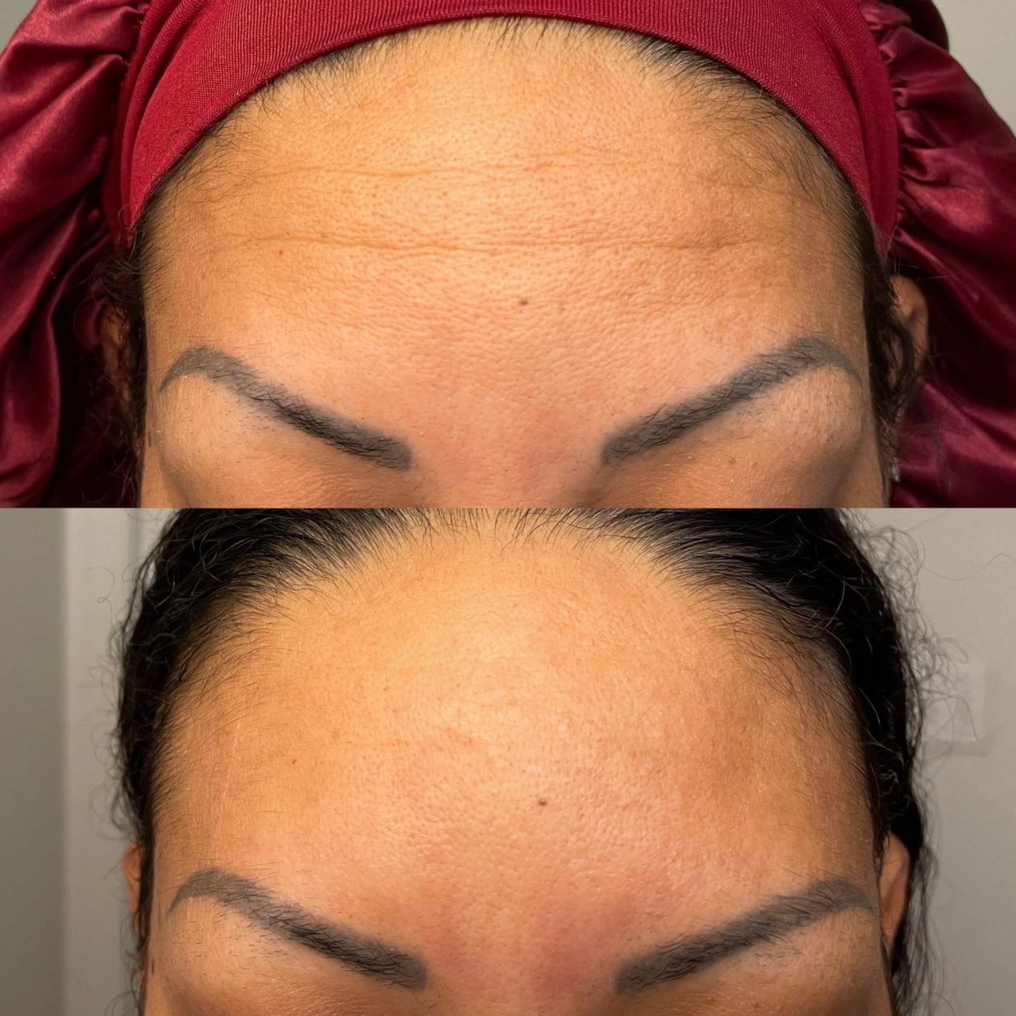 Before-and-after comparison of a girl using Frownies products: Before, she has visible wrinkles on her forehead; After, her skin appears much smoother with no wrinkles.