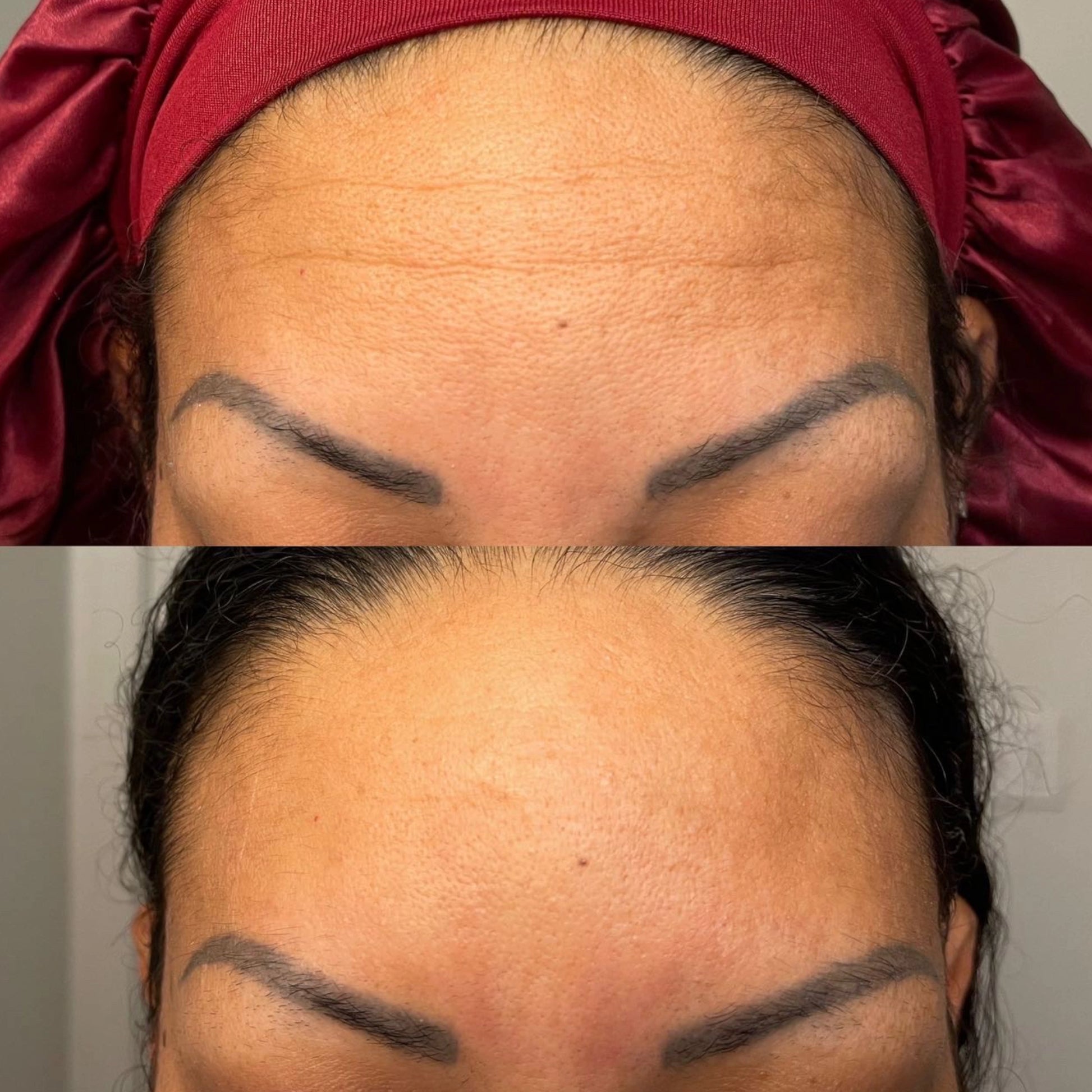 Before-and-after comparison of a girl using Frownies products: Before, she has visible wrinkles on her forehead; After, her skin appears much smoother with no wrinkles.