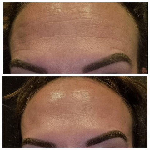 Before and after wrinkle patches Wrinkles on the forehead before using Frownies Facial Patches for smoothing wrinkles and lines and the same woman after using Frownies for forehead and between the eyes wrinkle patches the wrinkles are softened and smoothed