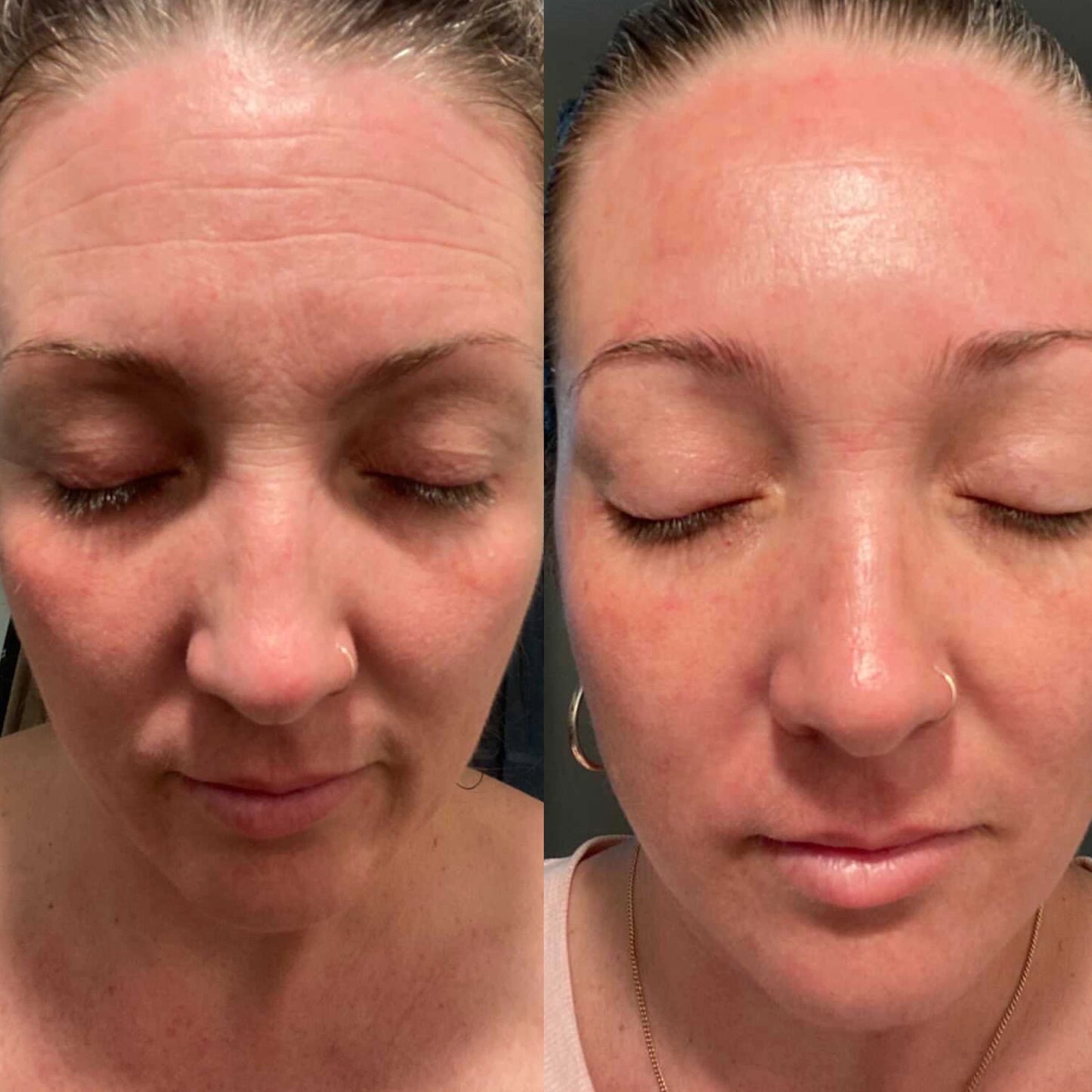 Before-and-after photo of a woman using Frownies: The 'before' image shows visible forehead wrinkles, while the 'after' image reveals her forehead looking smooth, refined, soft, and glowing.