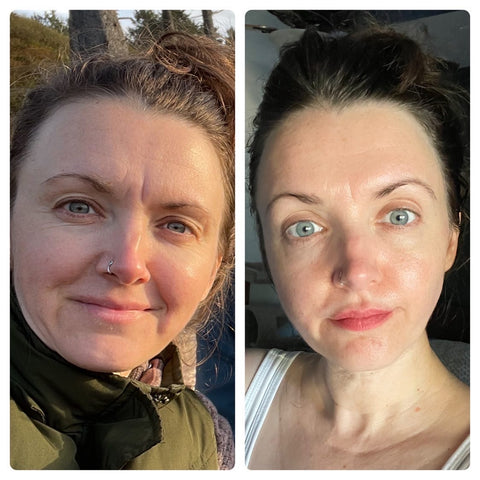 Wrinkles on the forehead before using Frownies Facial Patches for smoothing wrinkles and lines and the same woman after using Frownies for forehead and between the eyes wrinkle patches the wrinkles are softened and smoothed