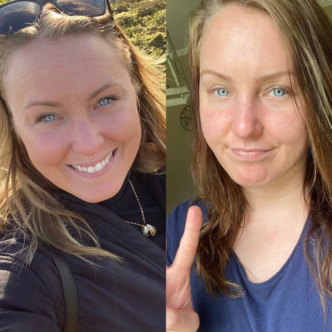 Wrinkles on the forehead before using Frownies Facial Patches for smoothing wrinkles and lines and the same woman after using Frownies for forehead patch  the wrinkles are softened and smoothed