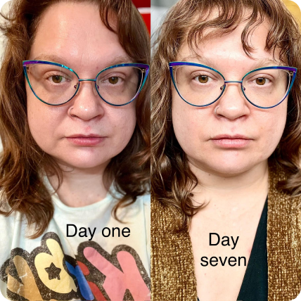 Devon Pearl split image before and after wearing frownies wrinkle patches to smooth forehead wirnkles
