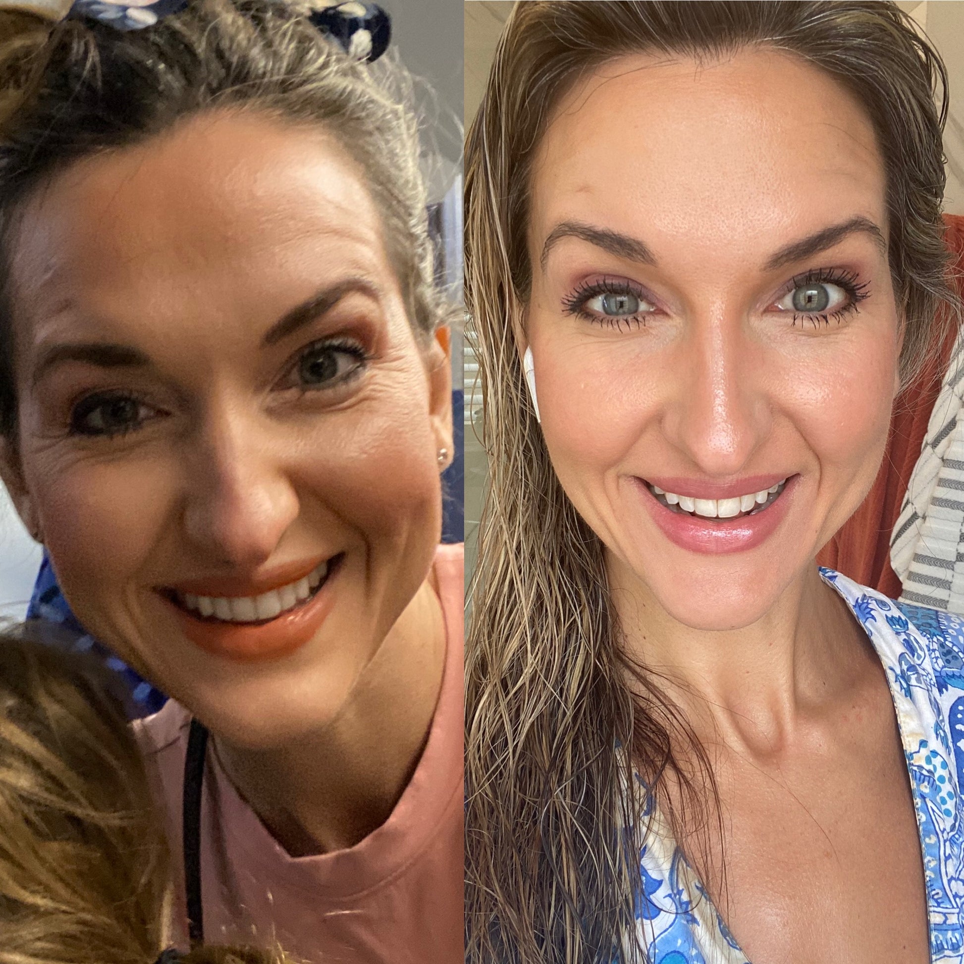 woman's before and after using Apple Serum-Malus Domestica-Apple Stem Cell Extract Skincare Products The Frownies to smooth crows feet  