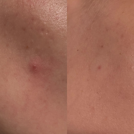 before and after of skin with blemish after using frownies pimple patches with essential oils