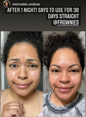 Wrinkles on the forehead before using Frownies Facial Patches for smoothing wrinkles and lines and the same woman after using Frownies for forehead and between the eyes wrinkle patches the wrinkles are softened and smoothed