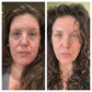 Before image with horizontal lines on the forehead after frownies image with a smooth forehead 