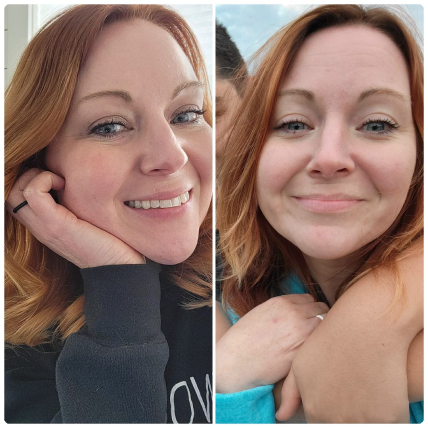 "It feels like silk!" split image of woman's face before and after wearing frownies wrinkle patches