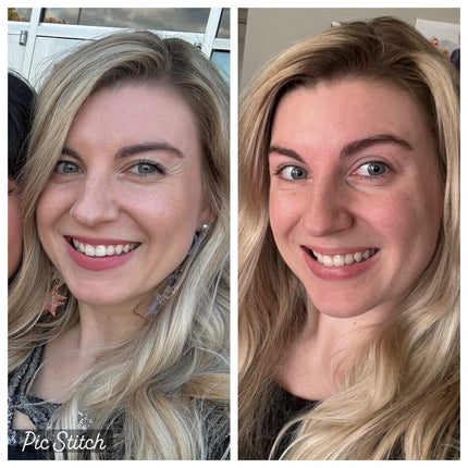 split image of woman's face Before and after frownies to smooth crows feet