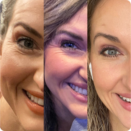 split image of woman before and after using frownies apple serum to smooth crows feet 