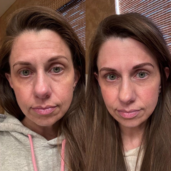 before and after using frownies facial patches for forehead wrinkles