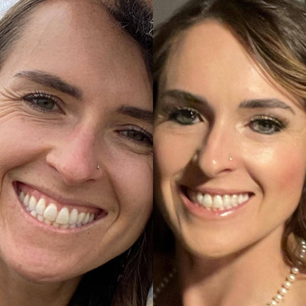 split image of woman's face before and after using frownies apple serum for crows feet