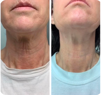 improvements_from_neck_masks
