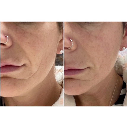 split image of woman's lower face Before and after frownies wrinkle patches for smile lines