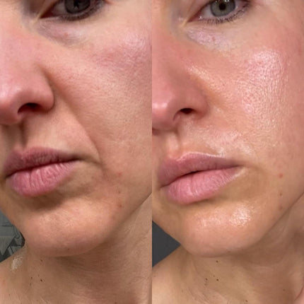 split image of woman's lower face Before and after frownies wrinkle patches for smile lines